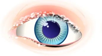 Blepharitis