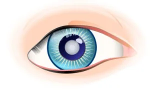 Cataracts
