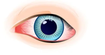 Conjunctivitis