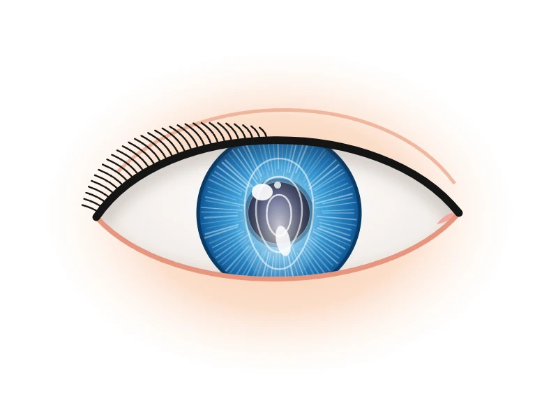 Keratoconus
