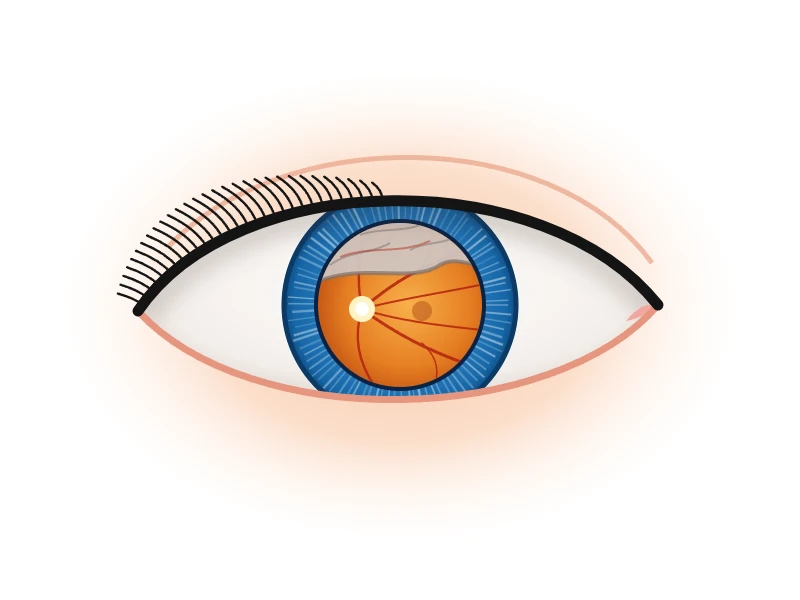 Retinal Detachment